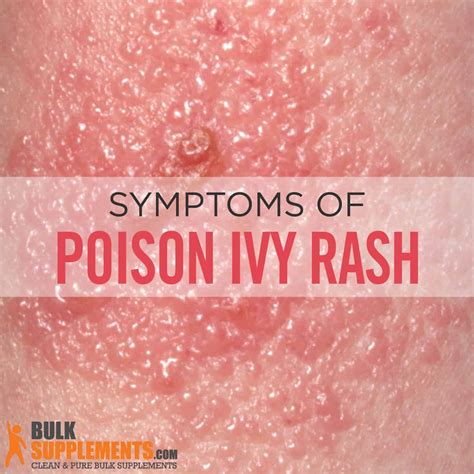How do you know if you have poison ivy rash?