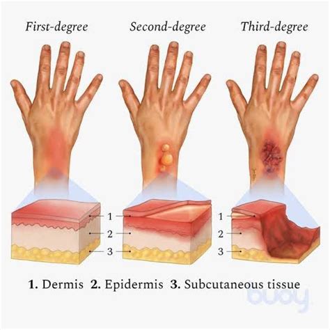 How do you know what degree a burn is?