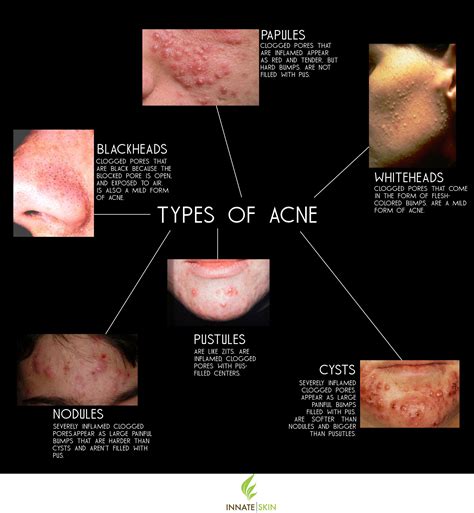 How do you know when acne is healing?