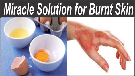 How do you make a burn stop hurting immediately?