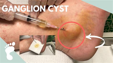 How do you make a cyst burst?