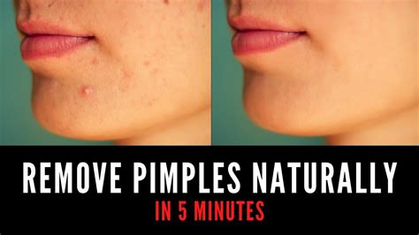 How do you make a pimple less red in 5 minutes?