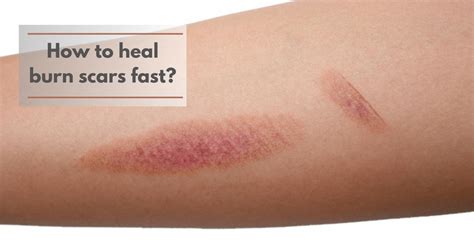 How do you make burn scars fade faster?