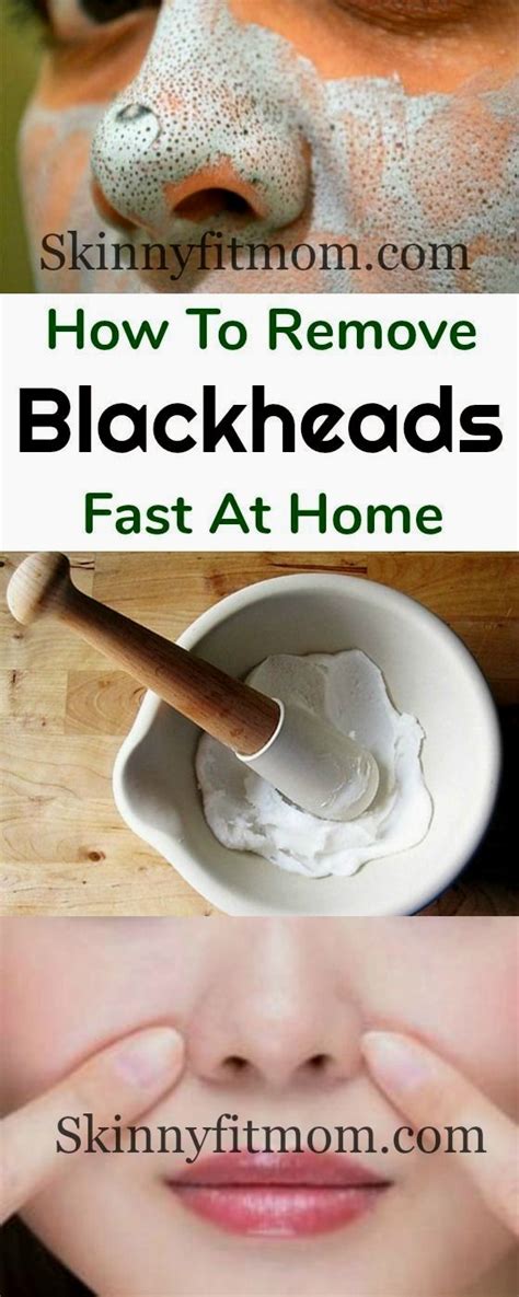 How do you make homemade blackhead remover?