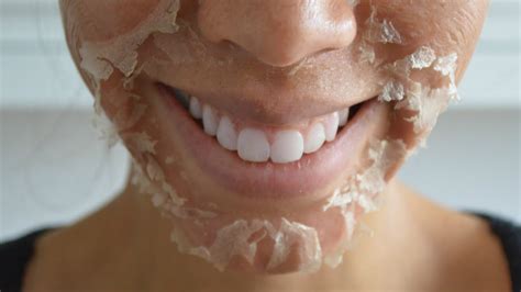 How do you make peeling skin heal faster?