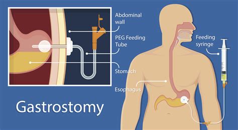 How do you measure a Gtube?