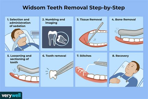 How do you mentally prepare for wisdom teeth removal?