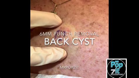 How do you pop a cyst that won't pop?