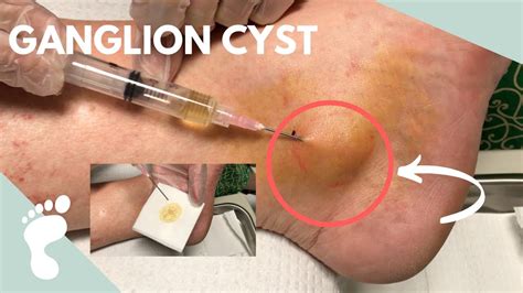 How do you pop a cyst with a needle at home?