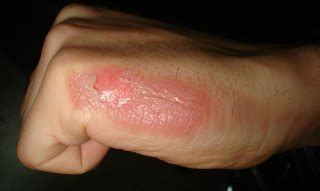 How do you prevent a 2nd degree burn from scarring?