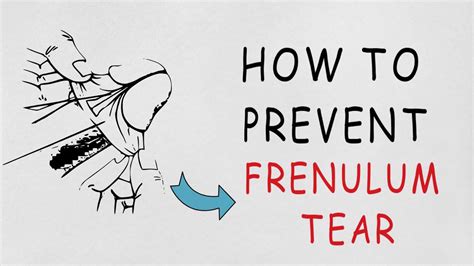 How do you prevent a frenulum tear?