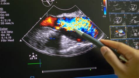 How do you read ultrasound colors?