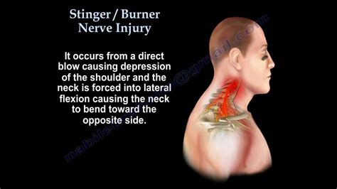 How do you rehab a shoulder stinger?