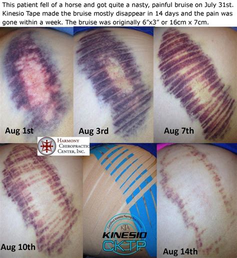How do you remove Kinesio tape residue from skin?