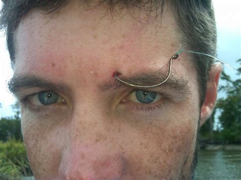 How do you remove a fish hook injury?