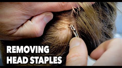 How do you remove a staple head?