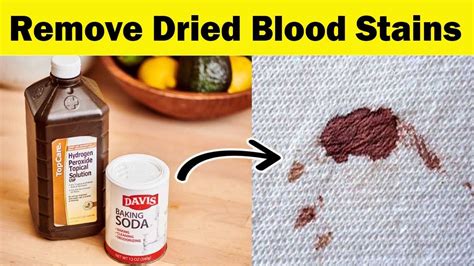 How do you remove blood stains after drying?