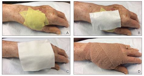How do you remove liquid bandage after surgery?