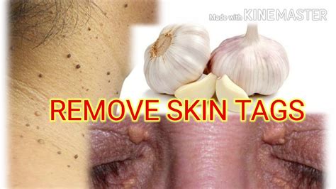 How do you remove skin tags with garlic?