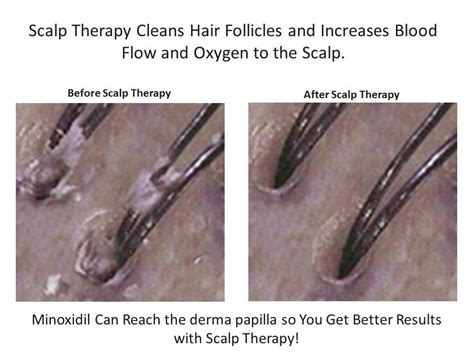 How do you reopen hair follicles?