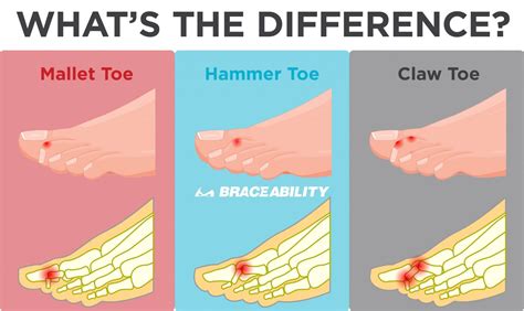 How do you reverse a bent toe?