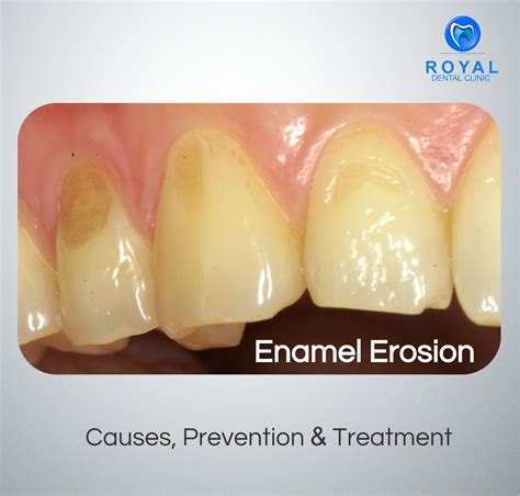 How do you reverse enamel damage?