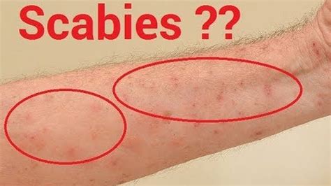 How do you rule out scabies?