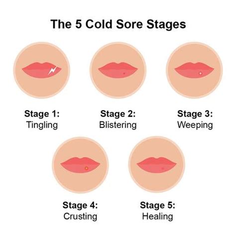 How do you shorten a cold sore?