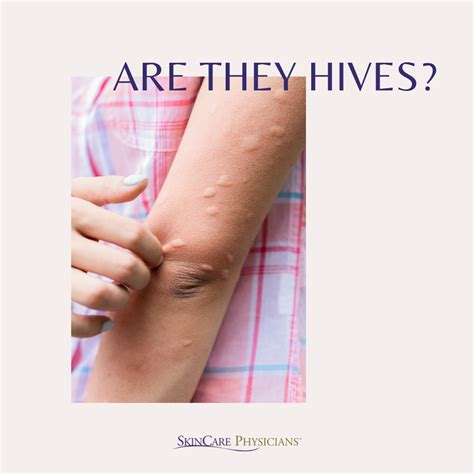 How do you shower with hives?