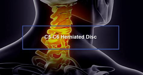 How do you sleep with a herniated C5-C6?