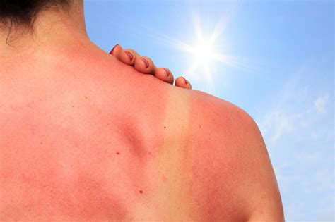 How do you sleep with a really bad sunburn?