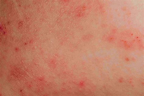 How do you sleep with an itchy rash?