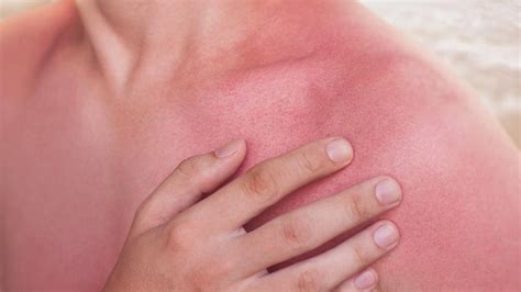 How do you sleep with an itchy sunburn?