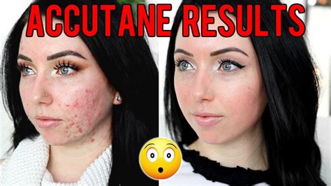 How do you stay healthy on Accutane?