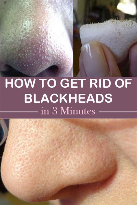 How do you steam blackheads?