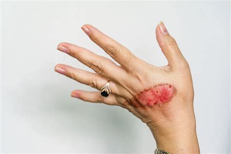How do you stop a burn from hurting your finger?
