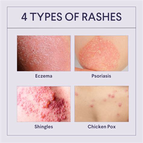 How do you stop a rash from spreading?