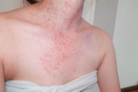 How do you stop folliculitis from spreading?