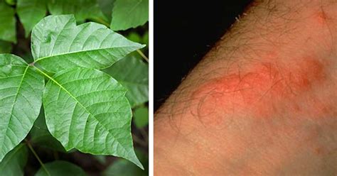 How do you stop poison ivy from spreading?