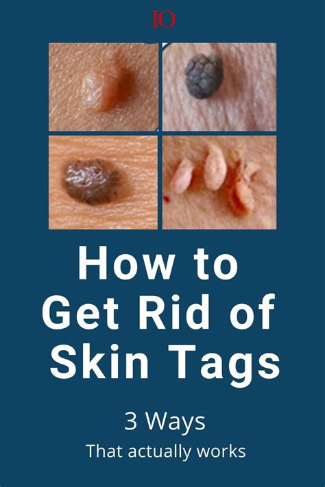 How do you stop skin tags from getting bigger?