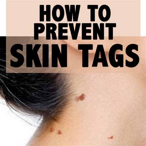How do you stop skin tags from growing on your neck?