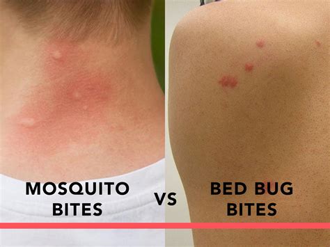 How do you tell if a bite is from a mosquito?