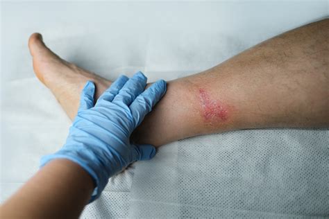 How do you tell if a burn is infected or healing?