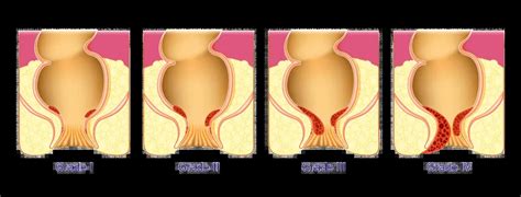 How do you tell if a lump is a hemorrhoid?