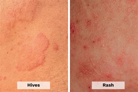 How do you tell if a rash is an allergy?