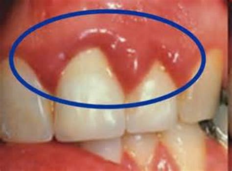How do you treat a bacterial infection in your gums?