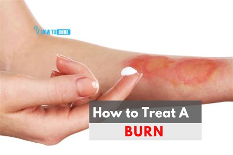 How do you treat a burn that doesn't hurt?