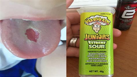 How do you treat a burnt tongue from sour candy?