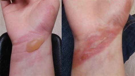 How do you treat a second-degree burn without scarring?