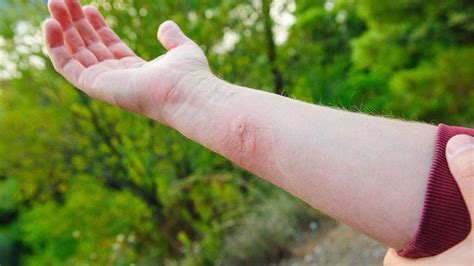 How do you treat a stinger on your arm?